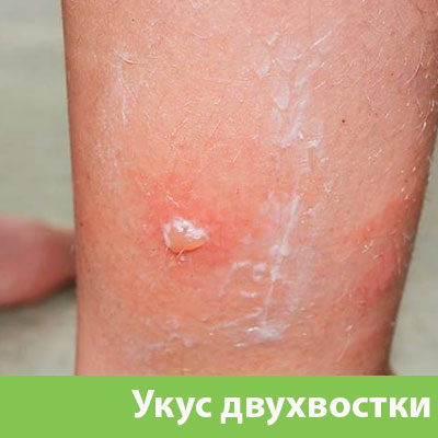 Укус двухвостки в Воскресенске