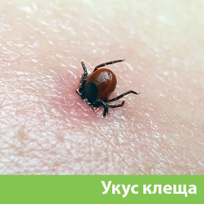 Укус клеща в Воскресенске