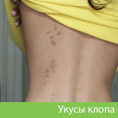 Профессиональное уничтожение клопов в Воскресенске